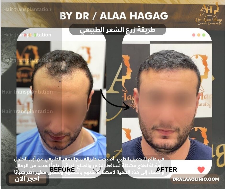 طريقة زرع الشعر الطبيعي لاستعادة كثافة الشعر | دكتور علاء