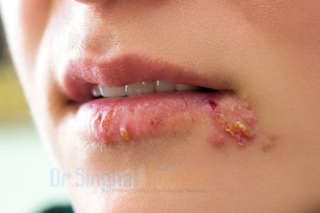 Herpes – Causes, Symptoms & Natural Cure